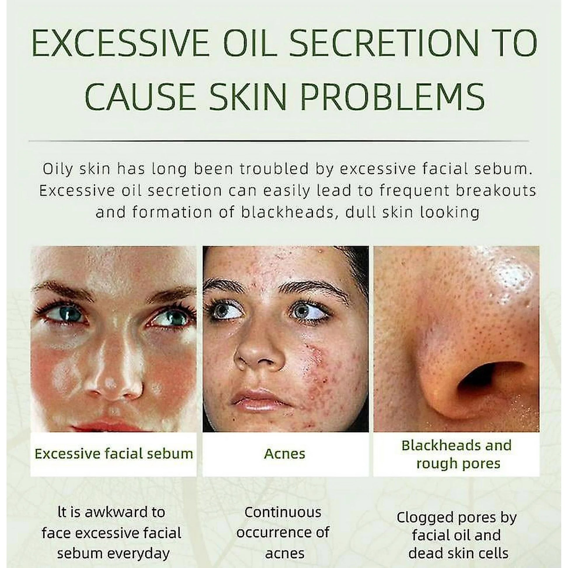 Herbal Acne Cream - Joypretty Herbal Day Cream For Acne Skin Care Face Moisturizer