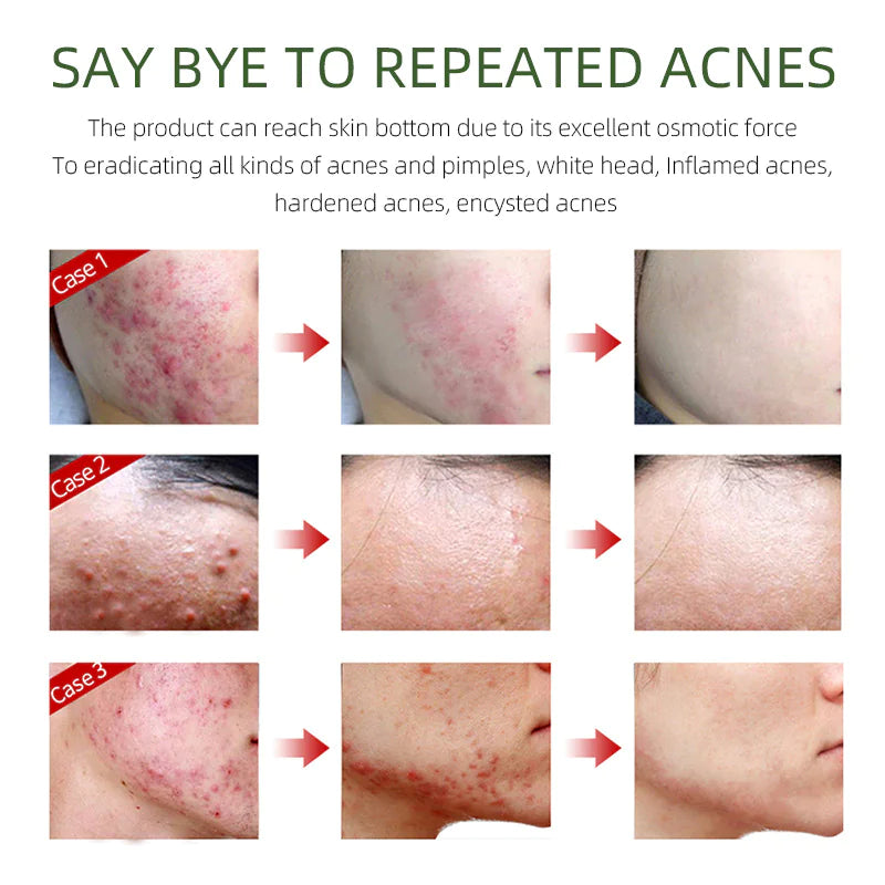 Herbal Acne Cream - Joypretty Herbal Day Cream For Acne Skin Care Face Moisturizer