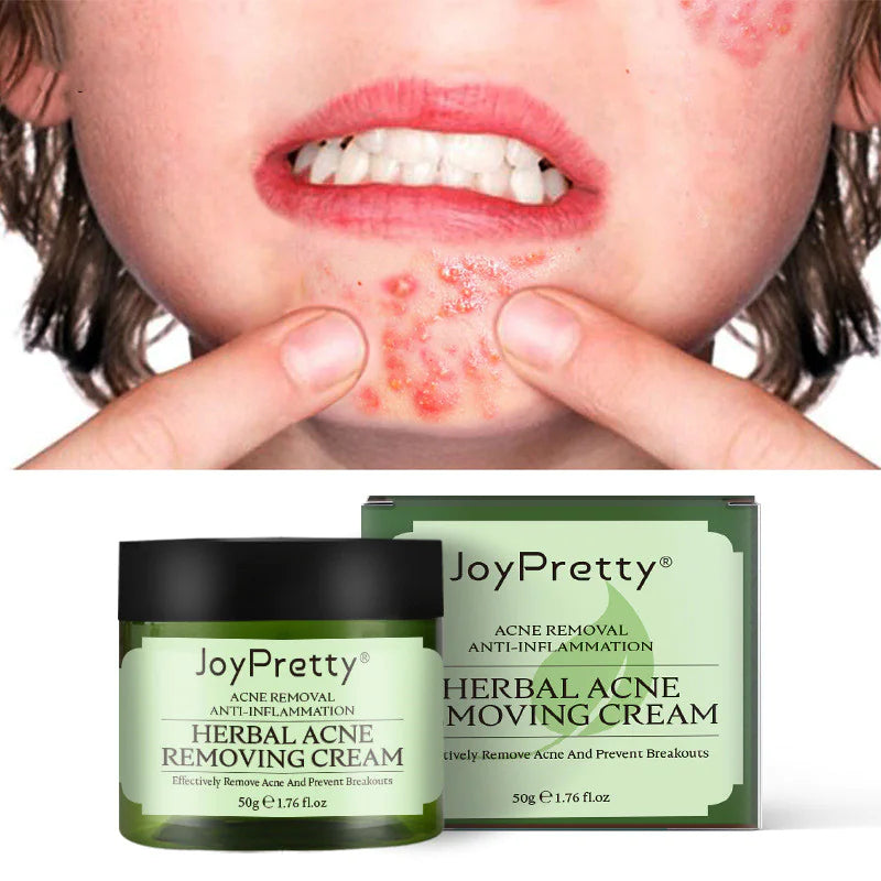 Herbal Acne Cream - Joypretty Herbal Day Cream For Acne Skin Care Face Moisturizer