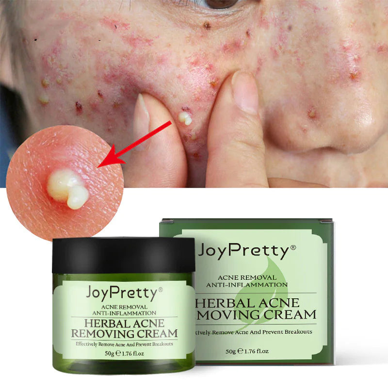 Herbal Acne Cream - Joypretty Herbal Day Cream For Acne Skin Care Face Moisturizer